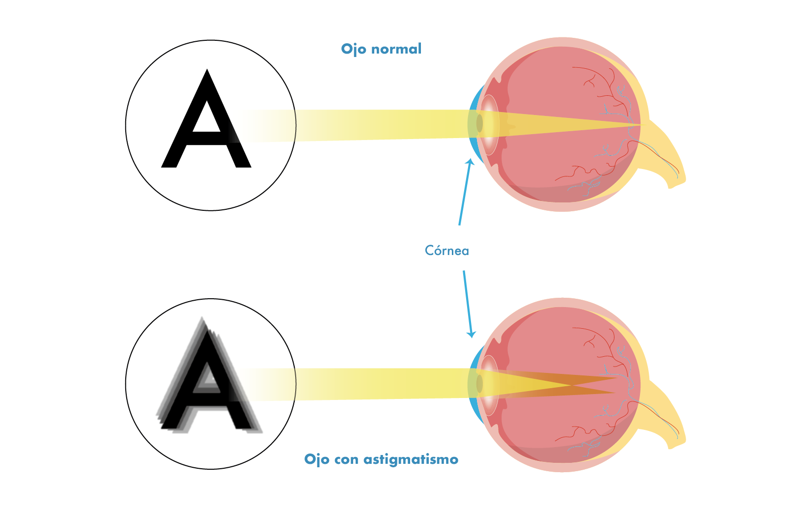 ¿Qué tipos de astigmatismo hay?