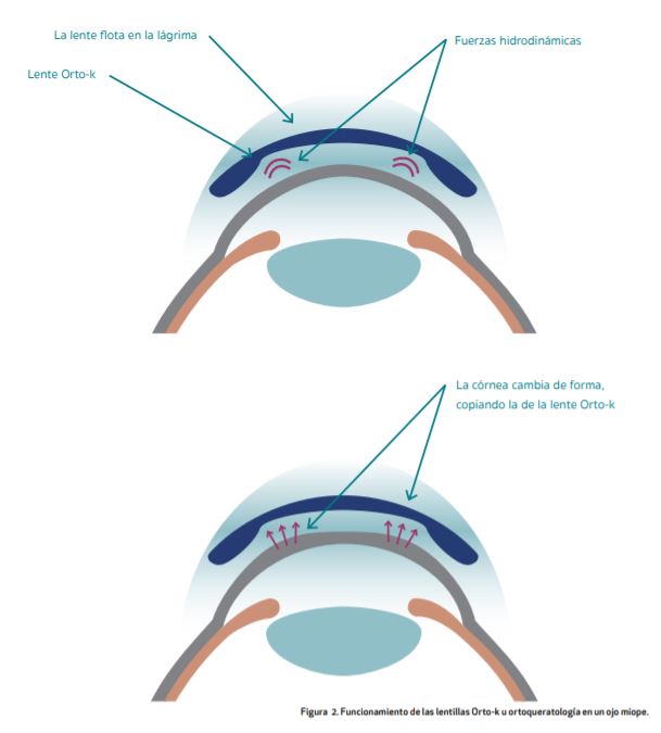Funcionamiento de las lentillas Orto-k u ortoqueratología en un ojo miope.
