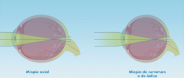 Tipos de miopía