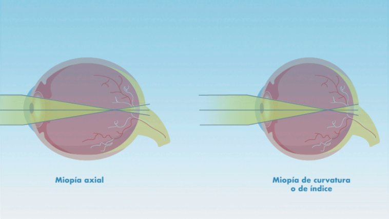 Tipos de miopía