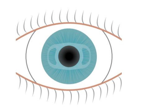  Lente intraocular de anclaje en el iris