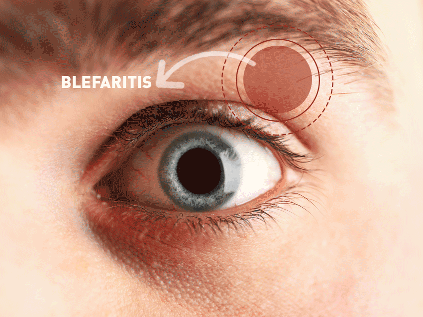 Blefaritis